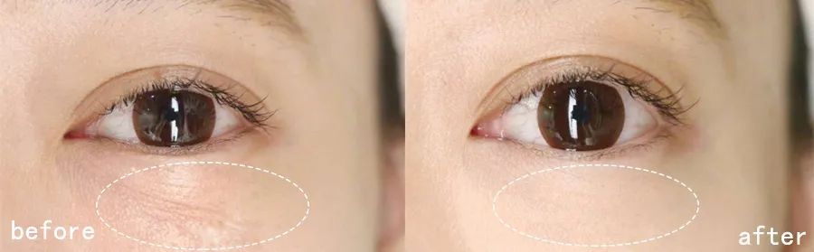 60岁没眼袋方法,教你一招去眼纹