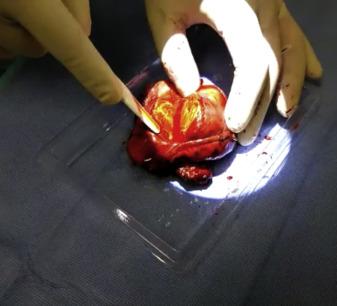 52岁男性肺部有肿块,老年男性胸痛的原因有哪些