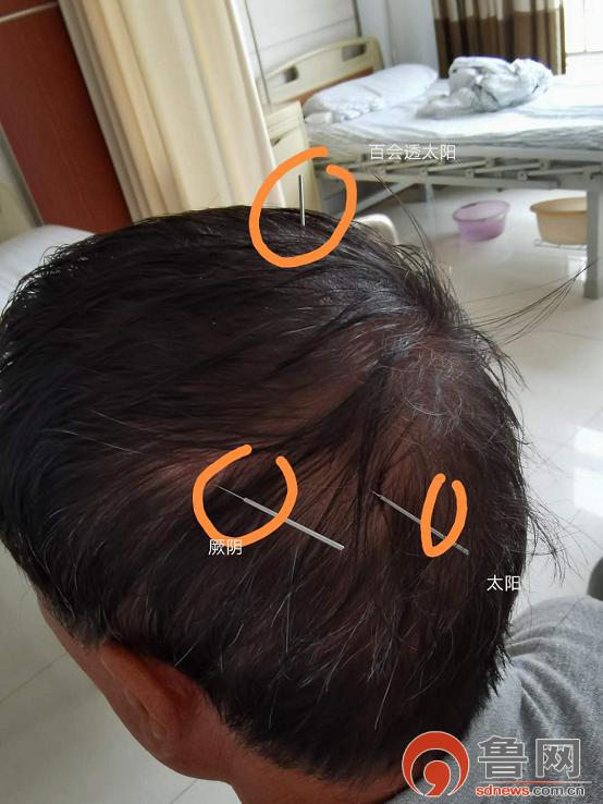 *安泰**市中医医院龙砂开阖六气针法助力脑病患者康复