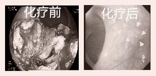 直肠癌扩散还有必要做手术么,直肠癌已经不能动手术了能活多久