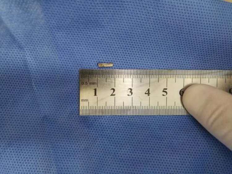 女子拔智齿后肿痛难忍检查发现,拔智齿后有异物