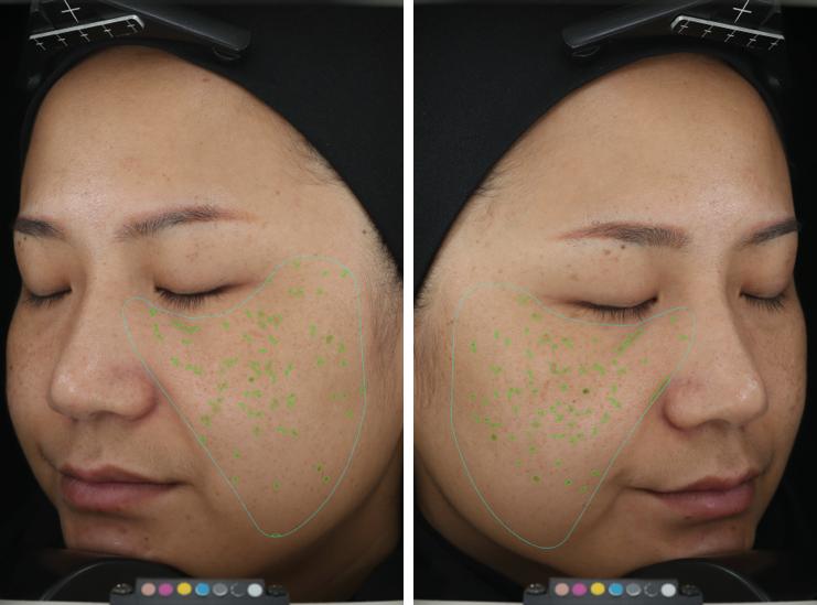 去斑点最有效方法医美去除斑痕,脸上暗沉有斑点可以做什么医美