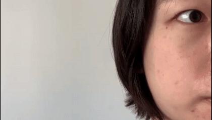 去斑点最有效方法医美去除斑痕,脸上暗沉有斑点可以做什么医美