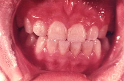 地方病防治宣传核心信息—碘缺乏病、包虫病、地方性氟中毒