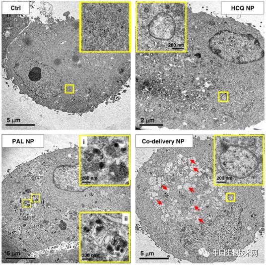 纳米刀治疗胰腺癌的效果及副作用,最新抗胰腺癌新药
