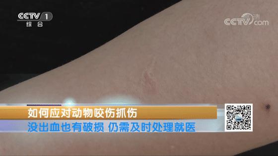 被动物咬伤的正确处理方法,被动物抓伤有什么症状