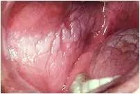 口腔溃疡超过两周一定是癌吗,口腔溃疡超过一个月不愈合应就诊