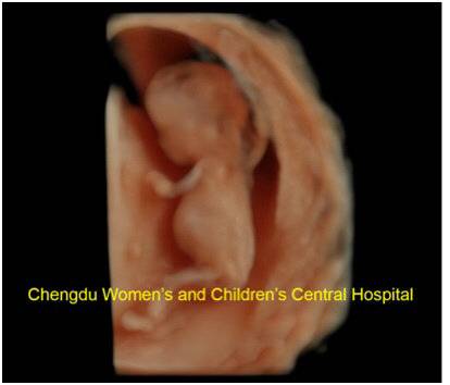 核磁确诊胎儿神经系统异常,胎儿中枢神经异常超声