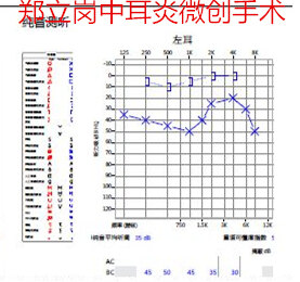 乳突炎中耳炎要做耳内镜吗,中耳乳突炎耳内镜手术