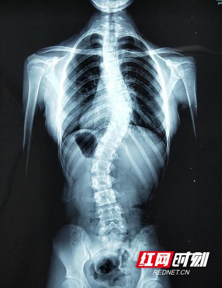 14岁女孩脊柱侧弯成S形原因是怕耽误学习没及时治疗