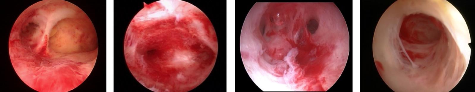 宫腔粘连了还能怀孕吗,宫腔粘连了还能取到卵吗