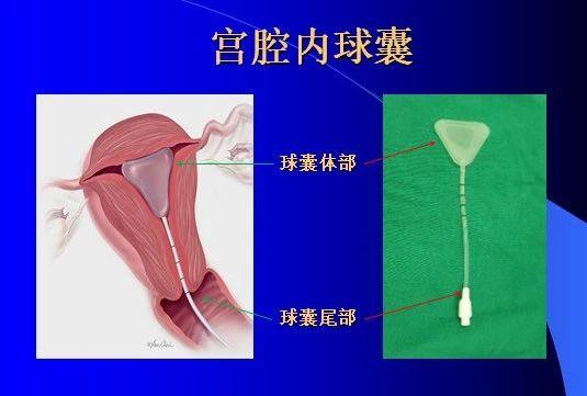 宫腔粘连了还能怀孕吗,宫腔粘连了还能取到卵吗
