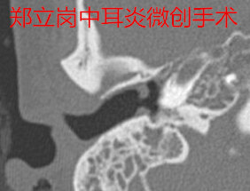 中耳炎手术住院要住多少天,中耳炎穿孔手术大概多少钱