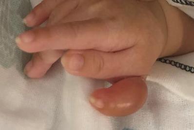 小孩长了6根手指怎么办,婴儿长出多根手指