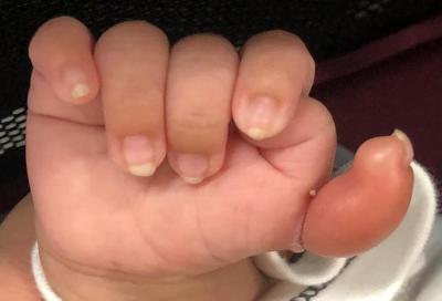 小孩长了6根手指怎么办,婴儿长出多根手指