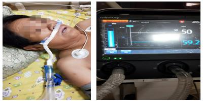 欧美呼吸机使用方法,蓝色呼吸机使用方法