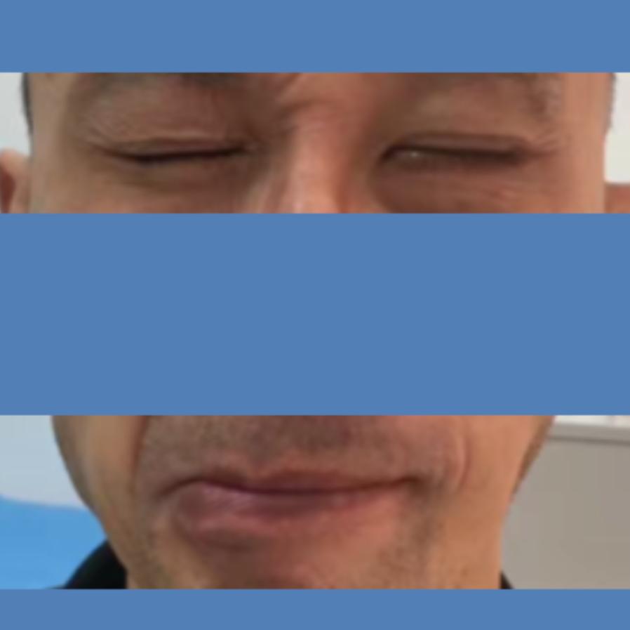 四川华西医院治疗面瘫怎么样,面瘫其实很难治愈