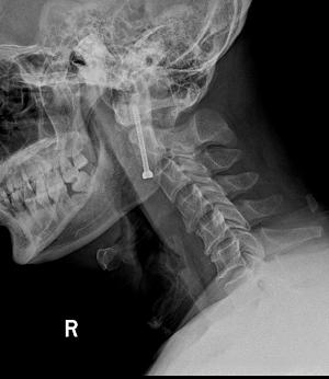 北京友谊医院微创外科,北京友谊医院骨科微创手术