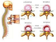 国家运动员腰椎间盘突出康复训练,武汉运动康复腰椎间盘突出