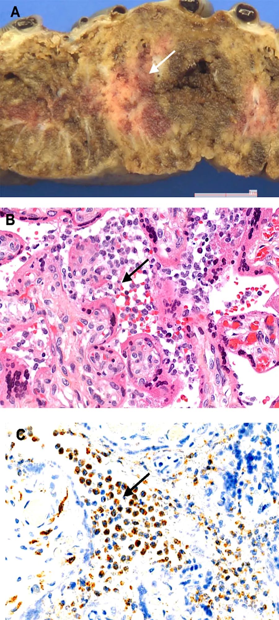 新冠病毒可通过母婴垂直传播吗？