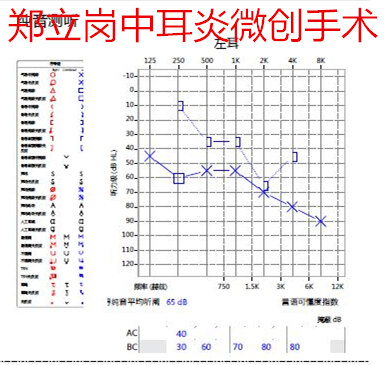 中耳炎耳内镜微创手术,内镜微创中耳炎