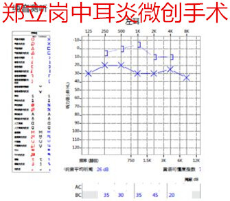 耳鼓膜穿孔一定要做手术吗,耳朵鼓膜穿孔手术费用多少