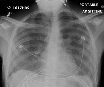 真菌感染是icu感染的第三大原因,真菌感染引起细菌感染