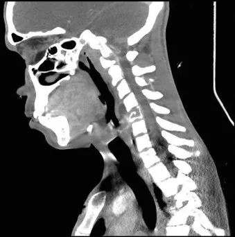 真菌感染是icu感染的第三大原因,真菌感染引起细菌感染
