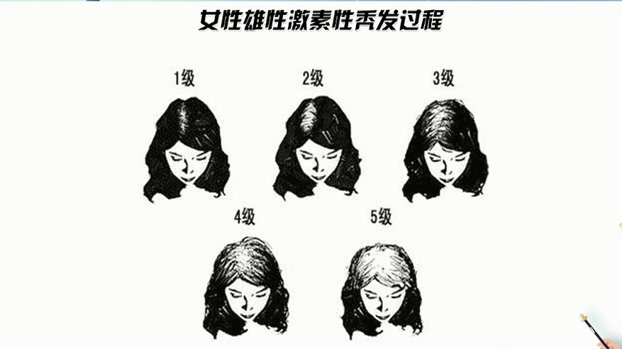 如何拯救“秃”如其来的尴尬？今晚19:30，收看海南卫视，为您揭晓答案