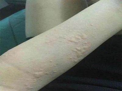 荨麻疹痒得要死,孩子荨麻疹痒死了怎么办