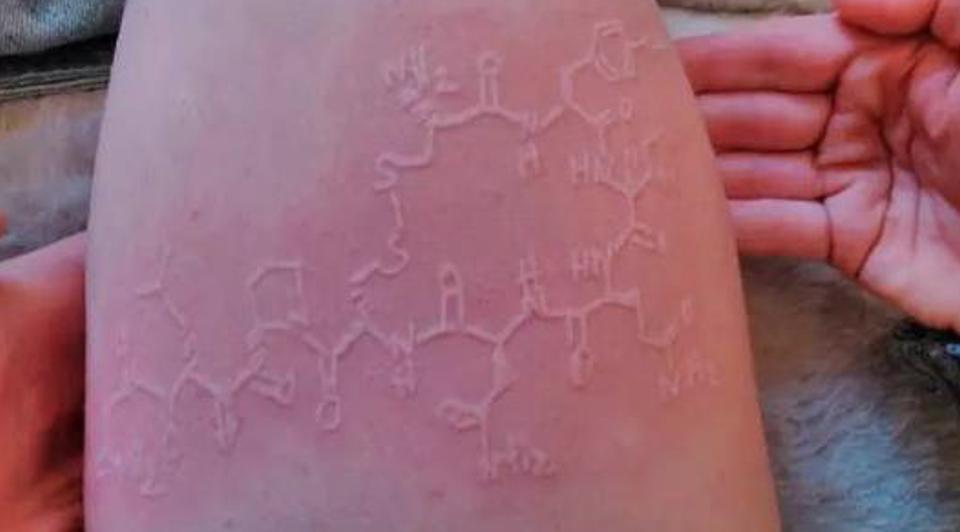 荨麻疹痒得要死,孩子荨麻疹痒死了怎么办