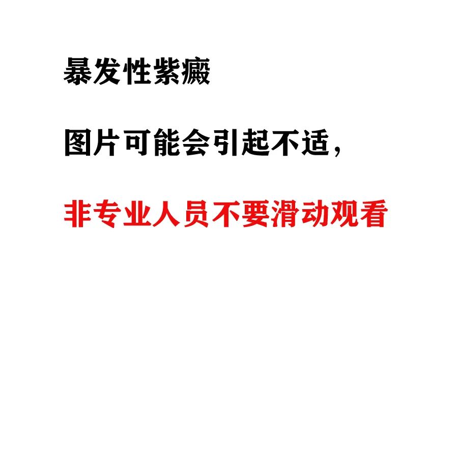 暴发性紫癜是什么原因引起的,暴发性紫癜是怎么回事