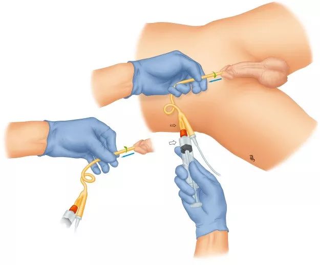 导尿管能打进去水但抽不出来,拔导尿管气囊怎么抽不出液体