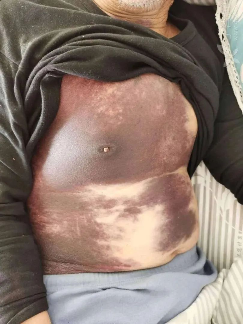 慢支肺征象,慢支急性发作处理