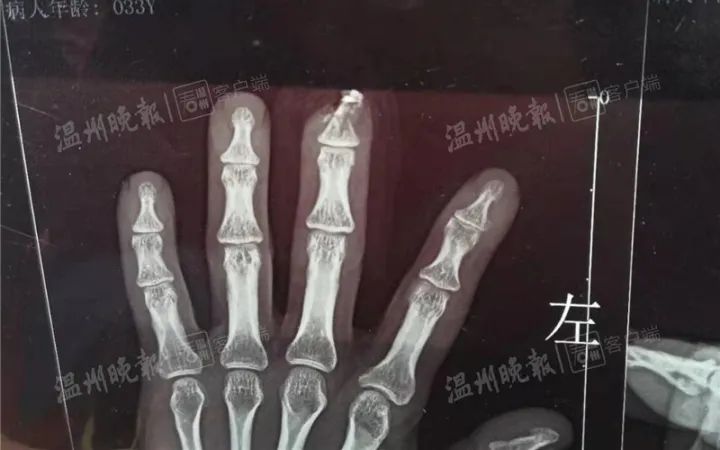 浙江一男子受伤，做完手术后短了一截？！医院回应了……