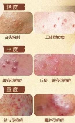 青春痘不用祛痘膏如何消除,青春痘不用药怎么治好