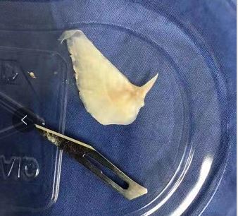 误吞2厘米鱼刺的最佳方法,男子误吞4厘米的鱼刺