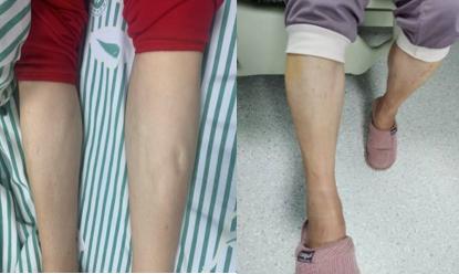 心力衰竭的胸腔积液有办法治疗吗,心力衰竭造成胸腔积液能治好吗