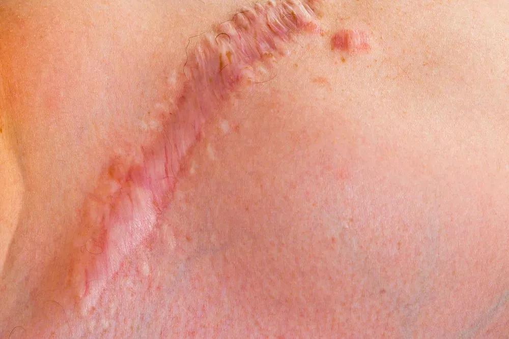 有效淡化疤痕的六个小妙招,贴上疤痕贴也长疤痕