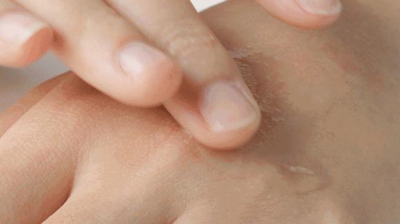 花了3万做激光，才彻底懂了：医生为什么劝你别去斑