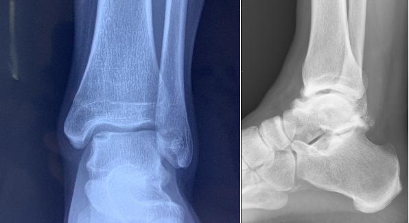 反复崴脚绝不是巧合,反复崴脚是渐冻症吗