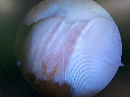 反复崴脚绝不是巧合,反复崴脚是渐冻症吗