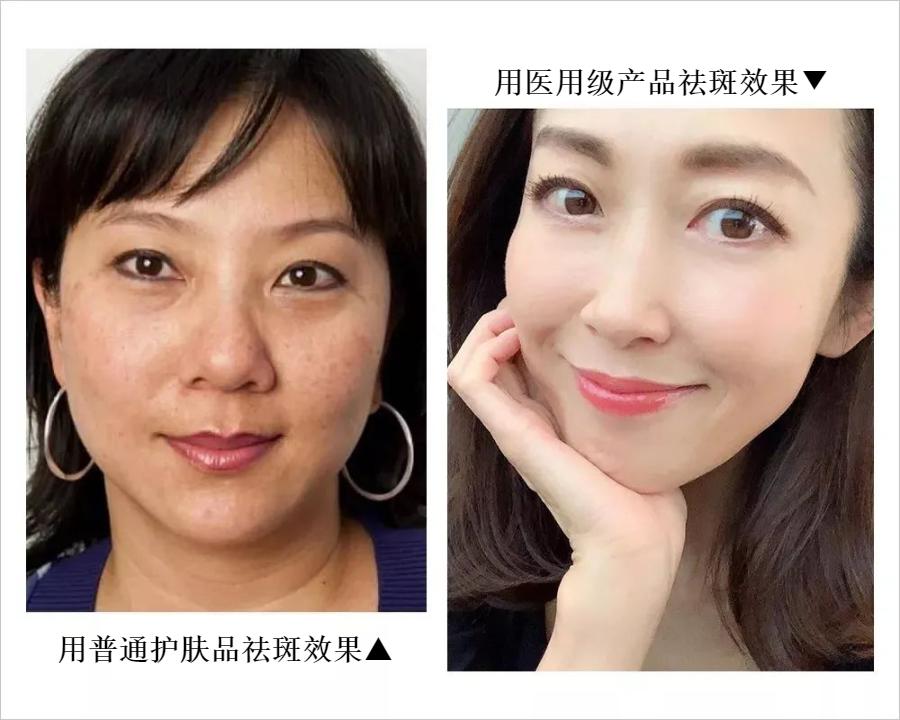 花了3万做激光，才彻底懂了：医生为什么劝你别去斑