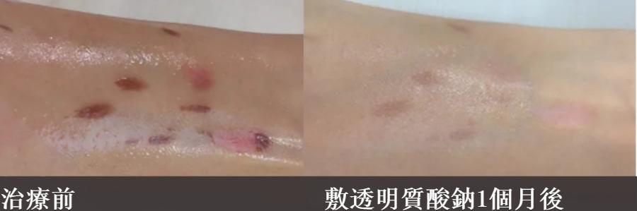 花了3万做激光，才彻底懂了：医生为什么劝你别去斑