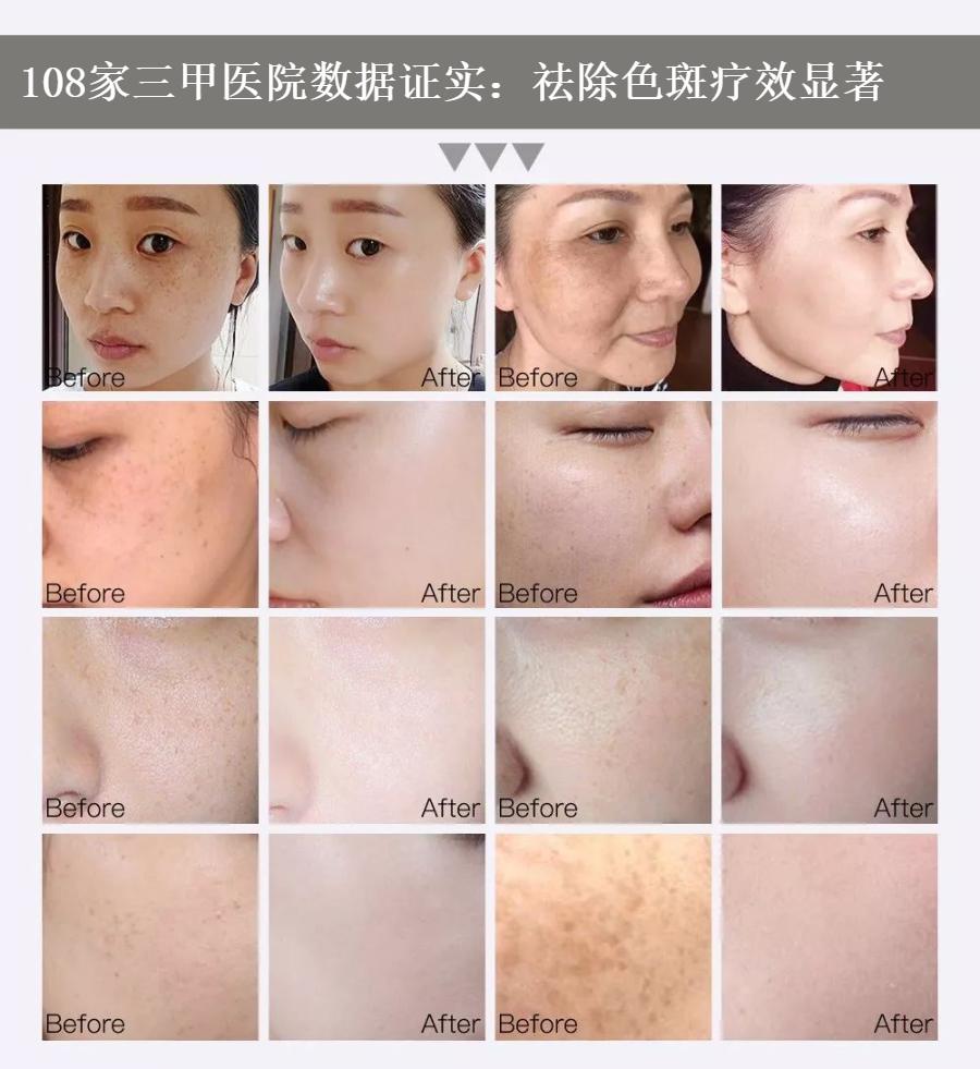 花了3万做激光，才彻底懂了：医生为什么劝你别去斑