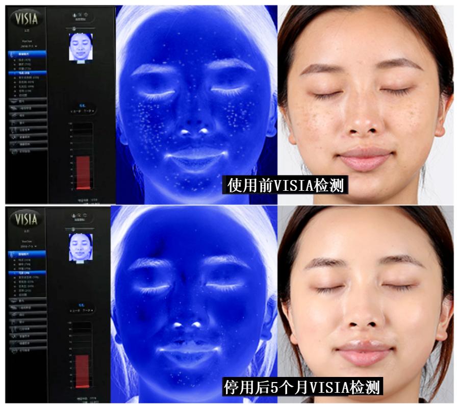 花了3万做激光，才彻底懂了：医生为什么劝你别去斑