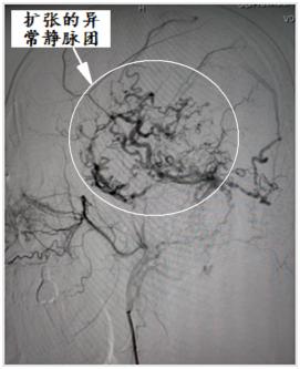 硬脑膜动静脉瘘介入栓塞后的治疗,宣武医院硬脑膜动静脉瘘的治疗