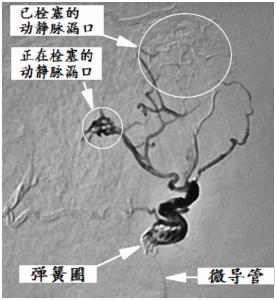 硬脑膜动静脉瘘介入栓塞后的治疗,宣武医院硬脑膜动静脉瘘的治疗