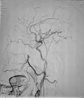 硬脑膜动静脉瘘介入栓塞后的治疗,宣武医院硬脑膜动静脉瘘的治疗