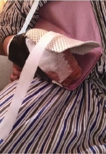 男孩捡未燃尽烟花被炸伤现场,男童把二踢脚拿在手里被炸伤